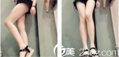 上海双孖张国华抽脂瘦腿真人案例：一个月的时间就让你摆脱烦人的大象腿