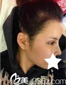 我在韩国青春整形做双眼皮+隆鼻术后10天图 我在韩国青春整形做双眼皮+隆鼻术后10天图