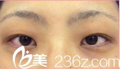森上和树双眼皮手术前 森上和树双眼皮手术前