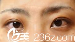 去日本城本整形外科医院找森上和树医生为我做了切开双眼皮，丑小鸭成了白天鹅!