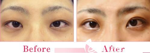 森上和树双眼皮手术前后对比 森上和树双眼皮手术前后对比