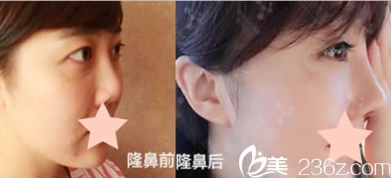 北京米兰柏羽丽都医疗美容曹卫华鼻综合隆鼻案例图