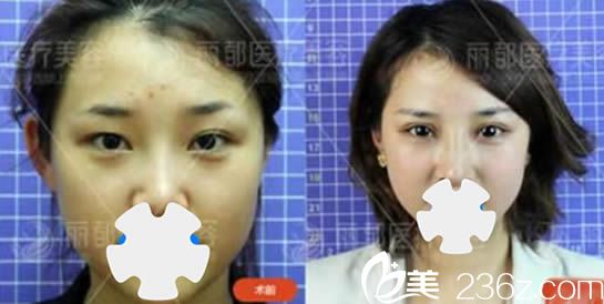 北京米兰柏羽丽都整形美容医院双眼皮案例效果图