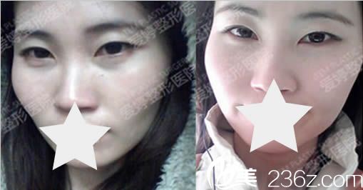 我在韩国爱婷整形医院面部整形术前照 我在韩国爱婷整形医院面部整形术前照