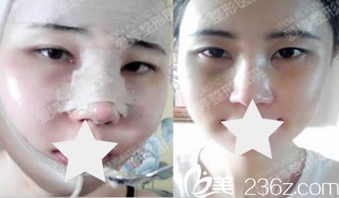 韩国爱婷整形隆鼻+磨颧骨术后照 韩国爱婷整形隆鼻+磨颧骨术后照