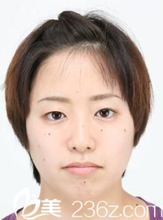 森上和树注射玻尿酸垫下巴前 森上和树注射玻尿酸垫下巴前