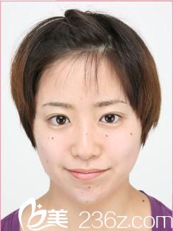 森上和树注射玻尿酸垫下巴后 森上和树注射玻尿酸垫下巴后
