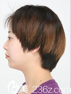 说说我去日本城本整形外科医院整形的经历，找森上和树医生为我注射玻尿酸塑下巴