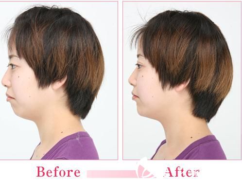 森上和树注射玻尿酸垫下巴前后对比照 森上和树注射玻尿酸垫下巴前后对比照