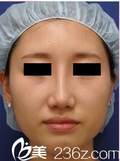 真实案例分享，找日本城本医疗美容医院的田中真辅医生给我做的硅胶假体隆鼻