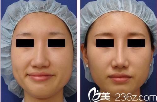 田中真辅隆鼻手术前后对比 田中真辅隆鼻手术前后对比