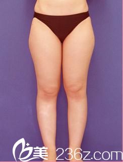 小川英朗吸脂手术前 小川英朗吸脂手术前