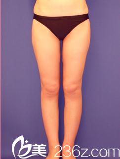 如何瘦大腿?日本城本医疗美容医院的小川英朗为我做了大腿吸脂，让我告别了大象腿