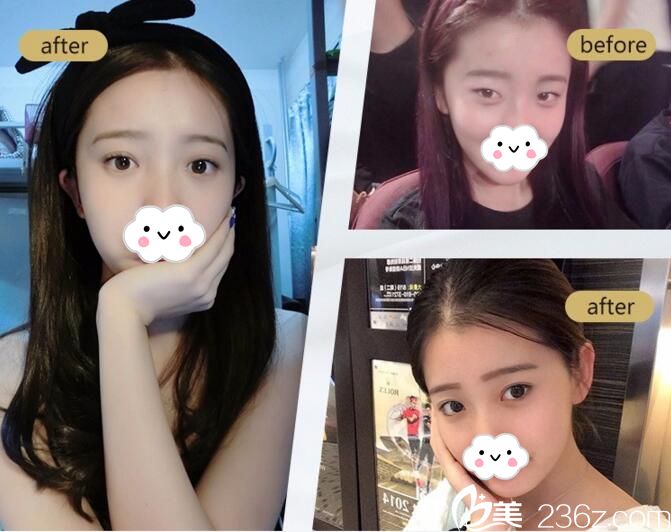 武汉叶子双眼皮案例