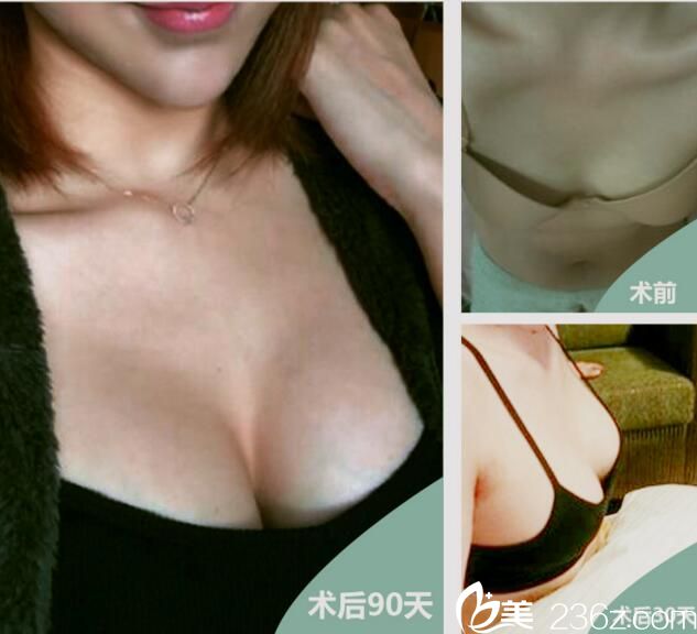 武汉叶子假体丰胸案例