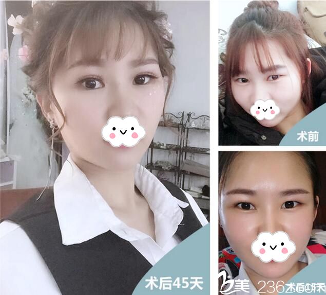 武汉叶子自体脂肪面部填充案例