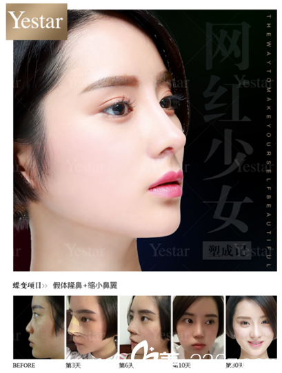 深圳yestar整形医院潘华做的鼻综合隆鼻案例 深圳yestar整形医院潘华做的鼻综合隆鼻案例