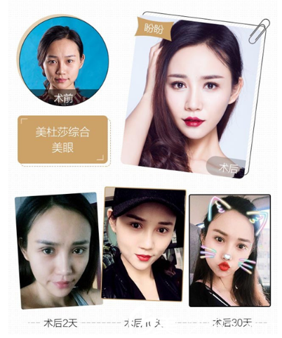 深圳yestar整形潘华做的美杜莎综合美眼双眼皮案例 深圳yestar整形潘华做的美杜莎综合美眼双眼皮案例