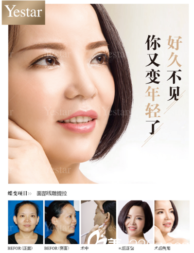 深圳艺星潘华做的面部线雕埋线提升案例 深圳艺星潘华做的面部线雕埋线提升案例