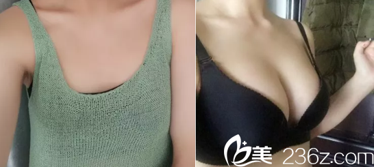 北京上上相自体脂肪隆胸多少钱？维秘明星艺术丰胸39800元起附案例