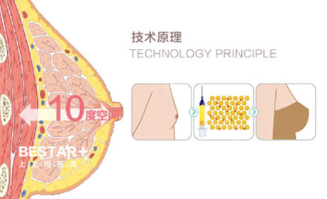 维秘明星艺术丰胸技术原理示意图 维秘明星艺术丰胸技术原理示意图