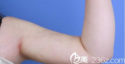 纤纤着素手---看我在湘南美容外科医院的中村大辅那里做的手臂吸脂案例