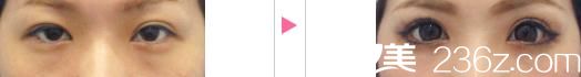 吉原伯切开法双眼皮前后对比 吉原伯切开法双眼皮前后对比