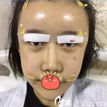 杭州容妍刚做完双眼皮修复和脂肪填充图片