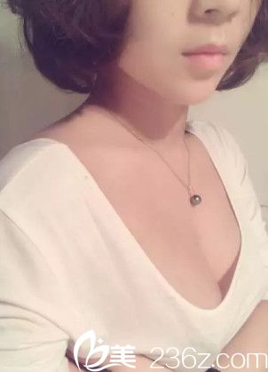 王立英院长做假体隆胸术后5天胸部微肿 王立英院长做假体隆胸术后5天胸部微肿