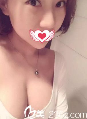 在秦皇岛巧致做假体隆胸16天胸部慢慢消肿 在秦皇岛巧致做假体隆胸16天胸部慢慢消肿