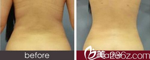 艾美整形医院吸脂前后对比