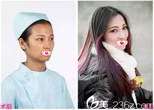 廊坊艾美假体隆鼻案例