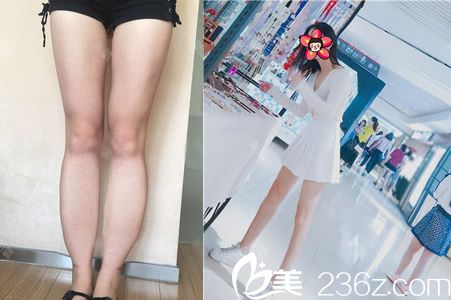 嘉兴艺星张占召小腿吸脂案例 嘉兴艺星张占召小腿吸脂案例