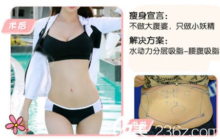 嘉兴艺星整形张占召腰腹吸脂案例 嘉兴艺星整形张占召腰腹吸脂案例