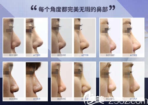 李炳浍做的鼻综合隆鼻整形案例组图