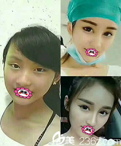 佛山梦露孙医生切开双眼皮前后变化图 佛山梦露孙医生切开双眼皮前后变化图