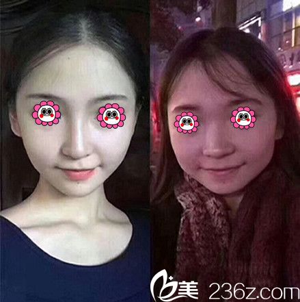 梦露整形医院游万福主任隆鼻效果图 梦露整形医院游万福主任隆鼻效果图