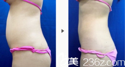 长大庭英信吸脂手术 长大庭英信吸脂手术