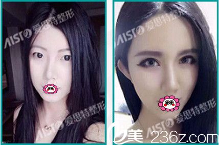 整形医院双眼皮前后对比图 整形医院双眼皮前后对比图