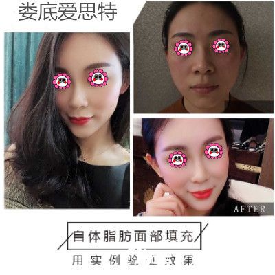 爱思特自体脂肪填充变化图 爱思特自体脂肪填充变化图