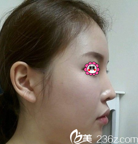 在北京画美做面部吸脂前样子 在北京画美做面部吸脂前样子