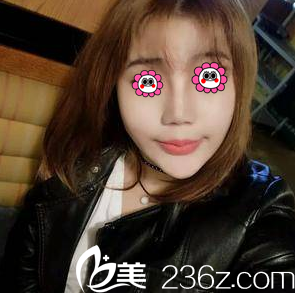 赵宏伟医生给我做面部吸脂第26天<span style= 赵宏伟医生给我做面部吸脂第26天<span style=