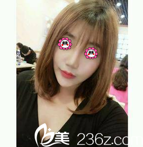 在北京画美做面部吸脂第48天样子 在北京画美做面部吸脂第48天样子