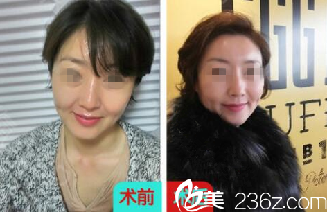 长春东方面部线雕提升案例