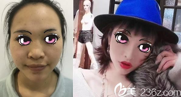 徐一波肋软骨鼻综合案例 徐一波肋软骨鼻综合案例