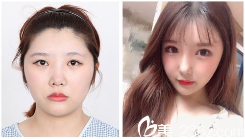 韩国faceline医院的颧骨缩小术+眼鼻综合对比图