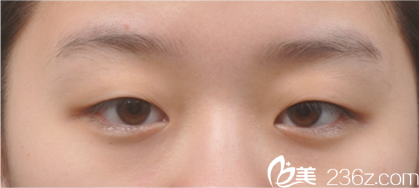 韩国新帝瑞娜(灰姑娘)医院眼提肌+双眼皮+前眼角术前 韩国新帝瑞娜(灰姑娘)医院眼提肌+双眼皮+前眼角术前