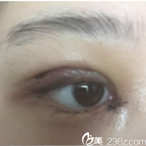 韩国新帝瑞娜（灰姑娘）医院眼提肌+双眼皮+前眼角术后2-10天