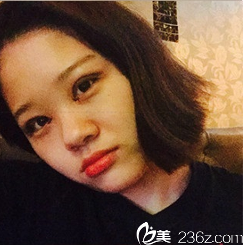 韩国新帝瑞娜(灰姑娘)医院眼提肌+双眼皮+前眼角术后2-10天 韩国新帝瑞娜(灰姑娘)医院眼提肌+双眼皮+前眼角术后2-10天