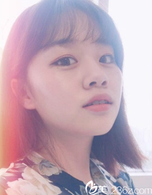 韩国新帝瑞娜(灰姑娘)医院眼提肌+双眼皮+前眼角术后3个月 韩国新帝瑞娜(灰姑娘)医院眼提肌+双眼皮+前眼角术后3个月